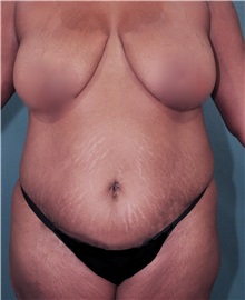 Liposuction Before Photo by Marvin Shienbaum, MD; Brandon, FL - Case 30384