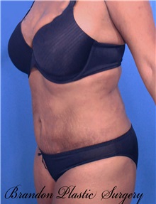 Liposuction After Photo by Marvin Shienbaum, MD; Brandon, FL - Case 30384