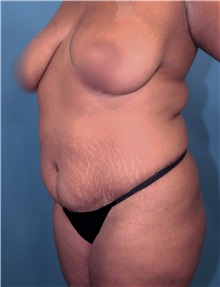 Liposuction Before Photo by Marvin Shienbaum, MD; Brandon, FL - Case 30384