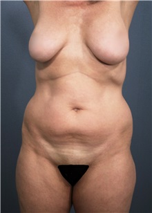 Liposuction Before Photo by Marvin Shienbaum, MD; Brandon, FL - Case 30391