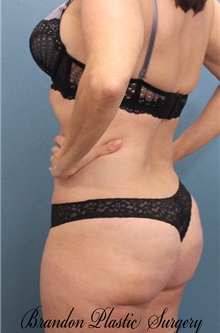 Liposuction After Photo by Marvin Shienbaum, MD; Brandon, FL - Case 30391