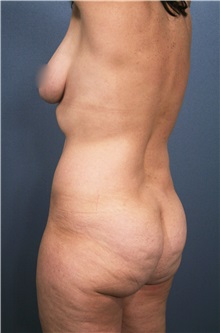 Liposuction Before Photo by Marvin Shienbaum, MD; Brandon, FL - Case 30391