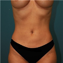 Liposuction After Photo by Marvin Shienbaum, MD; Brandon, FL - Case 30413