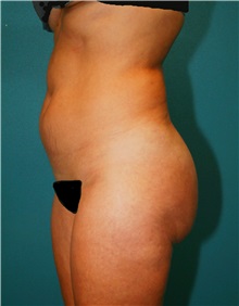 Liposuction Before Photo by Marvin Shienbaum, MD; Brandon, FL - Case 30413