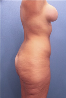 Liposuction Before Photo by Marvin Shienbaum, MD; Brandon, FL - Case 30417