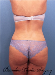 Liposuction After Photo by Marvin Shienbaum, MD; Brandon, FL - Case 30417