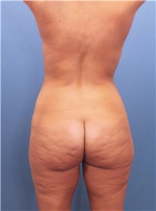 Liposuction Before Photo by Marvin Shienbaum, MD; Brandon, FL - Case 30417