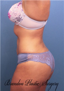 Liposuction After Photo by Marvin Shienbaum, MD; Brandon, FL - Case 30417