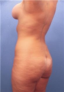 Liposuction Before Photo by Marvin Shienbaum, MD; Brandon, FL - Case 30417