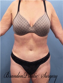 Liposuction After Photo by Marvin Shienbaum, MD; Brandon, FL - Case 30429