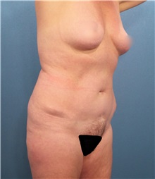 Liposuction Before Photo by Marvin Shienbaum, MD; Brandon, FL - Case 30429