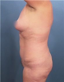 Liposuction Before Photo by Marvin Shienbaum, MD; Brandon, FL - Case 30429