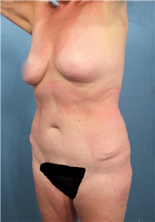 Liposuction Before Photo by Marvin Shienbaum, MD; Brandon, FL - Case 30429