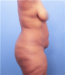 Liposuction Before Photo by Marvin Shienbaum, MD; Brandon, FL - Case 30436