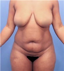 Liposuction Before Photo by Marvin Shienbaum, MD; Brandon, FL - Case 30436