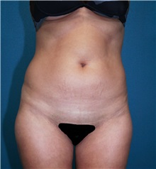 Liposuction Before Photo by Marvin Shienbaum, MD; Brandon, FL - Case 30439