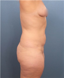 Liposuction Before Photo by Marvin Shienbaum, MD; Brandon, FL - Case 30440