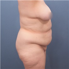 Tummy Tuck Before Photo by Marvin Shienbaum, MD; Brandon, FL - Case 30443