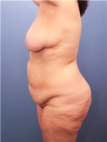 Tummy Tuck Before Photo by Marvin Shienbaum, MD; Brandon, FL - Case 30444