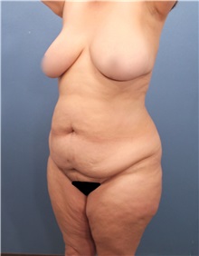 Tummy Tuck Before Photo by Marvin Shienbaum, MD; Brandon, FL - Case 30444