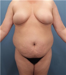 Tummy Tuck Before Photo by Marvin Shienbaum, MD; Brandon, FL - Case 30446