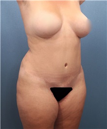 Tummy Tuck Before Photo by Marvin Shienbaum, MD; Brandon, FL - Case 30447