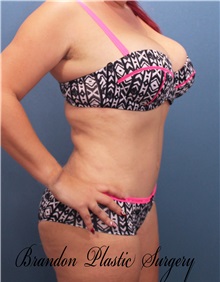 Tummy Tuck After Photo by Marvin Shienbaum, MD; Brandon, FL - Case 30447