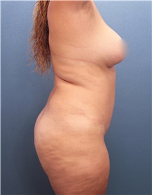 Tummy Tuck Before Photo by Marvin Shienbaum, MD; Brandon, FL - Case 30447