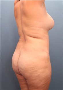 Tummy Tuck Before Photo by Marvin Shienbaum, MD; Brandon, FL - Case 30447