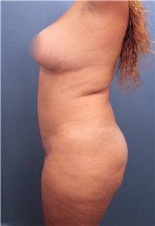 Tummy Tuck Before Photo by Marvin Shienbaum, MD; Brandon, FL - Case 30447