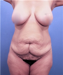 Tummy Tuck Before Photo by Marvin Shienbaum, MD; Brandon, FL - Case 30448