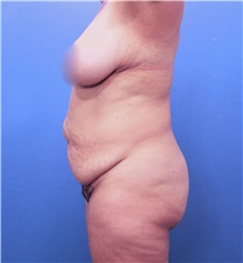 Tummy Tuck Before Photo by Marvin Shienbaum, MD; Brandon, FL - Case 30448