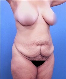 Tummy Tuck Before Photo by Marvin Shienbaum, MD; Brandon, FL - Case 30448