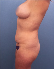 Tummy Tuck Before Photo by Marvin Shienbaum, MD; Brandon, FL - Case 30450