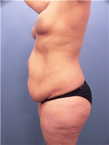 Tummy Tuck Before Photo by Marvin Shienbaum, MD; Brandon, FL - Case 30451