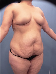 Tummy Tuck Before Photo by Marvin Shienbaum, MD; Brandon, FL - Case 30451