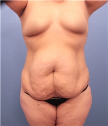 Tummy Tuck Before Photo by Marvin Shienbaum, MD; Brandon, FL - Case 30451