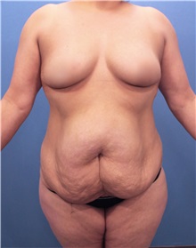 Tummy Tuck Before Photo by Marvin Shienbaum, MD; Brandon, FL - Case 30451