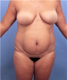 Tummy Tuck Before Photo by Marvin Shienbaum, MD; Brandon, FL - Case 30452