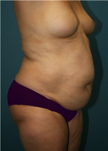 Tummy Tuck Before Photo by Marvin Shienbaum, MD; Brandon, FL - Case 30454