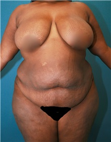 Tummy Tuck Before Photo by Marvin Shienbaum, MD; Brandon, FL - Case 30455