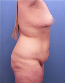 Tummy Tuck Before Photo by Marvin Shienbaum, MD; Brandon, FL - Case 30457