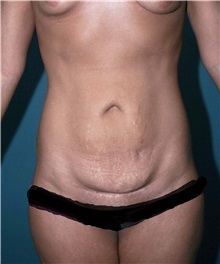 Tummy Tuck Before Photo by Marvin Shienbaum, MD; Brandon, FL - Case 30459