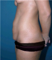 Tummy Tuck Before Photo by Marvin Shienbaum, MD; Brandon, FL - Case 30459