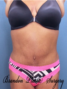 Tummy Tuck After Photo by Marvin Shienbaum, MD; Brandon, FL - Case 30460