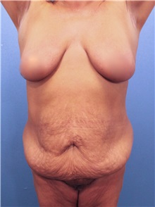 Tummy Tuck Before Photo by Marvin Shienbaum, MD; Brandon, FL - Case 30460