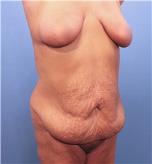 Tummy Tuck Before Photo by Marvin Shienbaum, MD; Brandon, FL - Case 30460