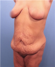 Tummy Tuck Before Photo by Marvin Shienbaum, MD; Brandon, FL - Case 30460