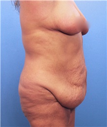 Tummy Tuck Before Photo by Marvin Shienbaum, MD; Brandon, FL - Case 30460