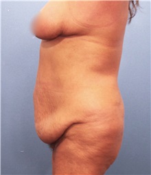 Tummy Tuck Before Photo by Marvin Shienbaum, MD; Brandon, FL - Case 30460